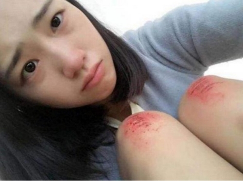 50+ Hình ảnh cô gái ngã xe trầy xước đầu gối, tuyệt chiêu không để lại sẹo